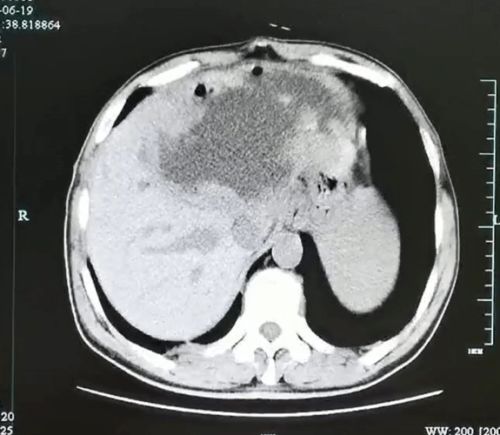 可怕 男子左肝长满了虫卵 只因吃了这种鱼