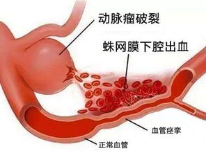 颅内动脉瘤不是肿瘤,最大的危险是破裂出血