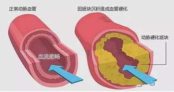 血管决定你的寿命 专家推荐餐桌上6大血管 清道夫