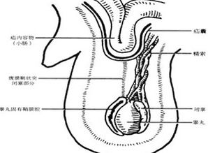 腹股沟疝，左侧腹股沟斜疝是什么病