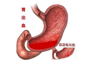 肝硬化发生胃出血为什么如此凶险,输血都不一定有效 