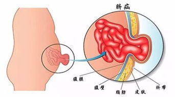 无知 1个月大婴儿肚脐外鼓,父亲竟一刀划开放气 真想让这样的父母持证上岗