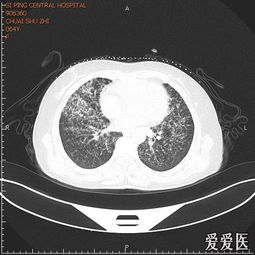 肺CT过几天出病理