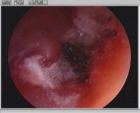 外耳道真菌图片 搜狗图片搜索