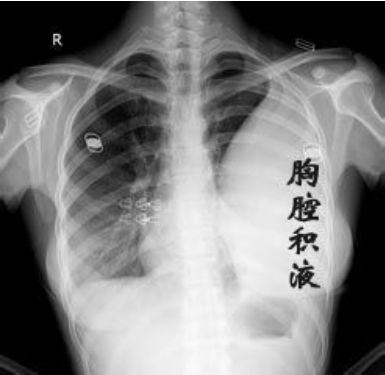 胸腔积液反反复复,还抽不抽 怎样才能有效治疗积液,避免反复