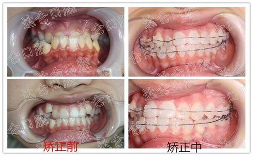 杭州比较好的牙科医院, 满口乱牙 的 隐形 蜕变之路