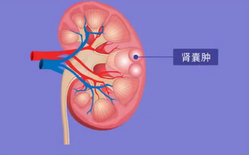 肾囊肿患者易走进的三大误区 你中了几条