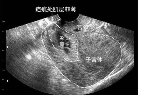 二次妊娠要当心子宫破裂，应避免胎儿过大