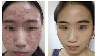 青春期的女生满脸是痤疮怎么治疗 推荐最有效的治疗痤疮痘印的方法 