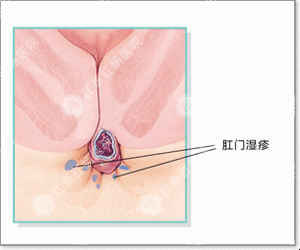 肛门湿疹是怎么回事(肛门湿疹是怎么回事男性)