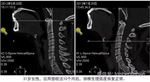 恢复颈椎曲度的方法,你值得珍藏