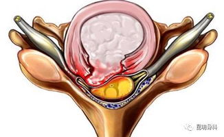 腰椎间盘突出患者一旦出现腿麻就麻烦了 