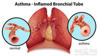过敏性支气管哮喘病因有哪些