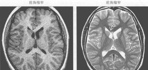 侧脑室后角，右侧侧脑室后角在人体脑部的哪个部位