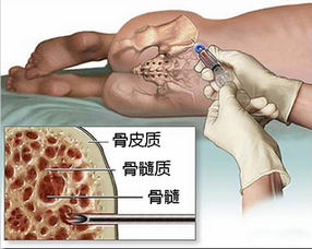 南宁仔捐干细胞救助马来患者 干细胞捐献知多少