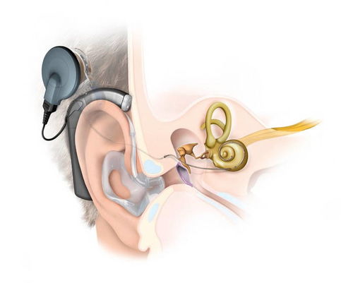 人工耳蜗和助听器有什么区别
