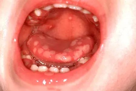 嘴巴上长疱疹是怎么回事，嘴巴下面长疱疹怎么回事