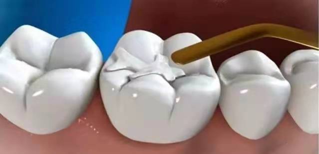 科普丨医生常说的嵌体和补牙有什么区别