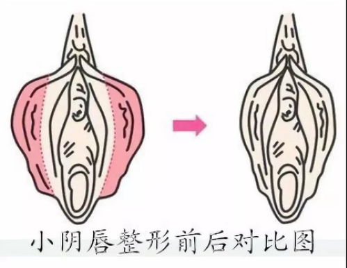 整形科普 小阴唇整形知多少