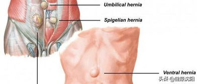 健康科普堂 疝非善类 谈一谈腹股沟疝的危害