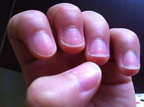 指甲盖凹凸不平顶针状凹陷,每个指甲都有明显竖纹,两个大拇指有月牙,左手2毫米,右手1毫米,特别短 