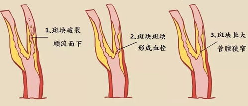 杜绝 坑蒙拐骗 颈动脉只有狭窄到这种程度才需放支架