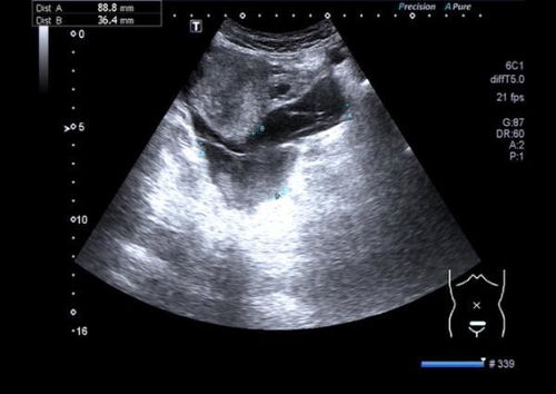盆腔积液超声检查能发现吗？可以成功试管助孕吗？