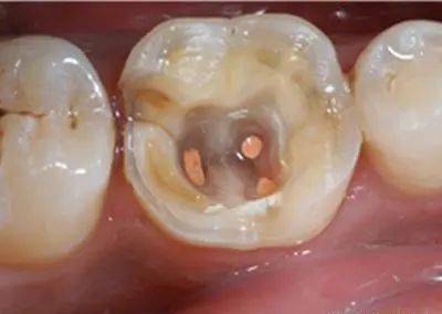 为什么有时牙齿表面只有一个小洞,却需要根管治疗
