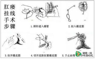 肛瘘的常见并发症有哪些 肛瘘会并发哪些疾病