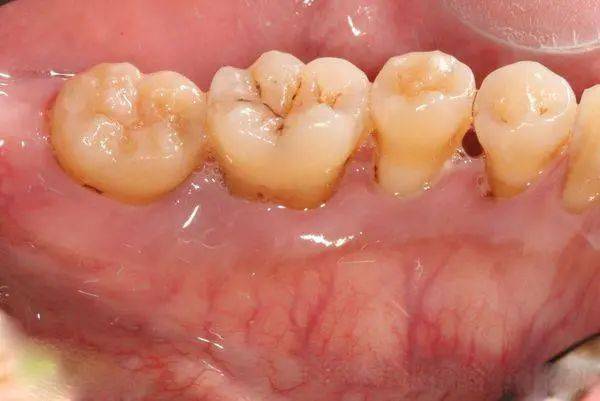学术分享 龈下刮治和根面平整术联合激光治疗牙周炎的研究进展