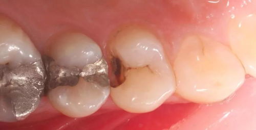 小看龋齿 蛀牙 当心可能造成大危害