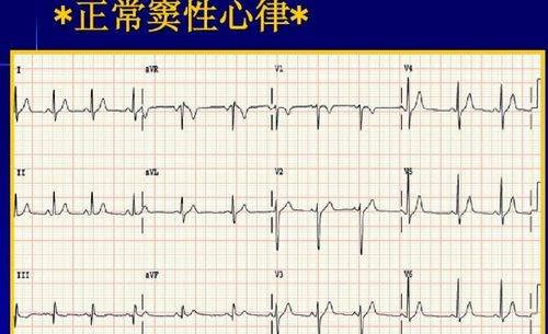 窦性心律高耸T波是什么意思 