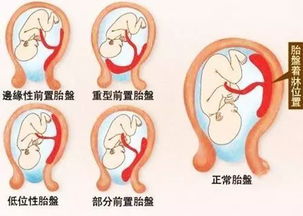 什么是胎盘低置 孕妇想要胎盘长上去,孕期做好6点 
