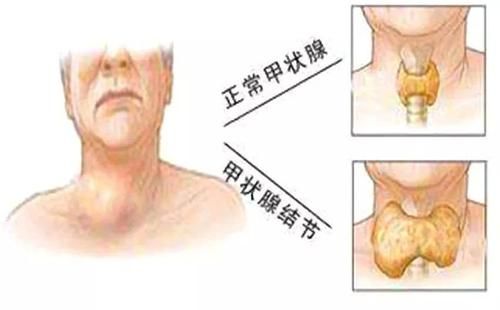 甲状腺手术泛滥不仅4大伤害不可逆,还要长期服药和 变丑