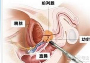 前列腺癌诊断治疗指南