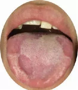 你的舌头也会生病 