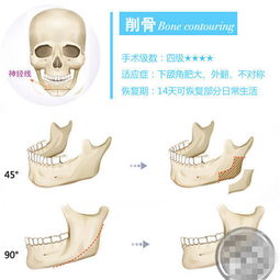 削骨 什么是削骨