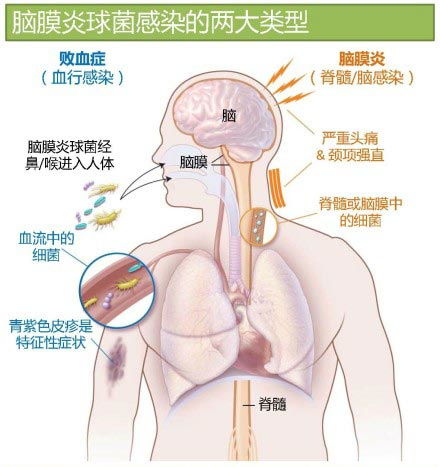 因父母错把脑膜炎当成感冒,孩子严重脑损伤,该如何区分呢