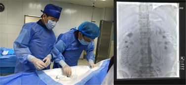 西安交大二附院妇产科实施省内首例腹主动脉球囊阻断术成功救治植入型凶险型前置胎盘
