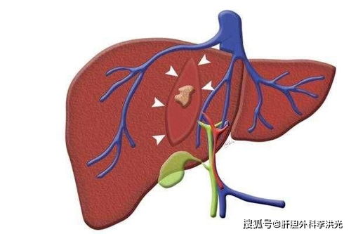 体检发现肝囊肿是怎么回事 是肿瘤吗 要不要紧