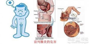 慢性前列腺炎容易治疗吗