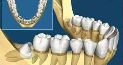 智齿一定要拔吗 拔智齿有什么危害