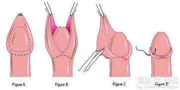 割包皮的好处和坏处(割包皮好处和坏处)