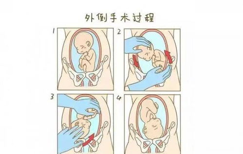 分娩交流 胎儿臀位该如何选择分娩方式 一定要剖腹产吗