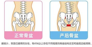 产后为什么要做骨盆修复 答案都在这