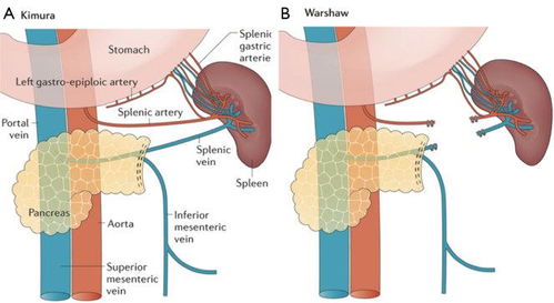 何为胰腺囊腺瘤 为什么胰腺粘液性囊腺瘤需要手术