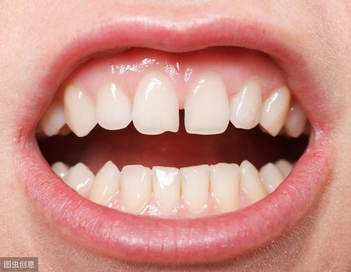 为什么牙缝越来越大 可能是这3种疾病引起的,别不当回事