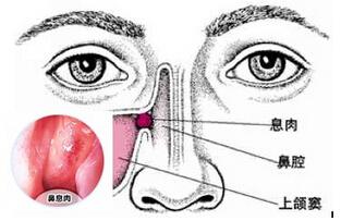 如何判断自己是否得了鼻息肉