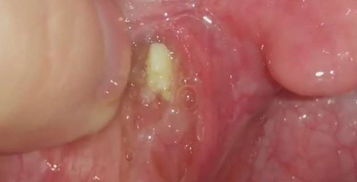 喉咙里咳出的黄色小颗粒到底是什么
