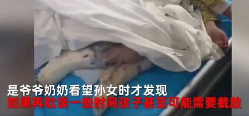 贵州身边事 4岁女孩疑遭后妈虐待烧伤险截肢